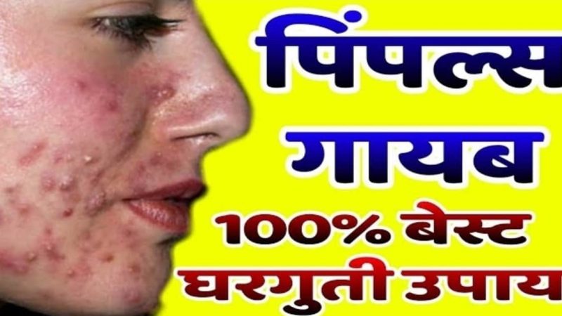 चेहऱ्यावरील पिंपल्सला कंटाळलायत का.? करा हा रामबाण उपाय, एका रात्रीत पिंपल्स गायब.!