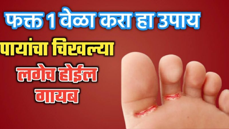 पावसातील चिखल्या दूर करण्याचे हे रामबाण उपाय एकदा अवश्य बघा; उपाय वाचून तुम्हीही व्हाल थक्क.!