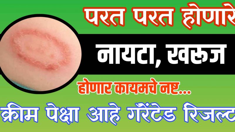 पुन्हा पुन्हा होणारे नायटा खरूज कायमचे होतील नष्ट; फक्त करा हा साधा उपाय.!