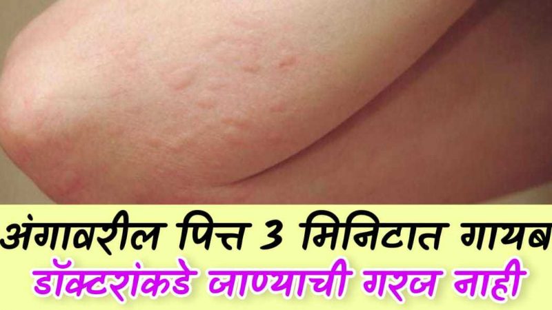 अंगावरील पित्त ३ मिनिटात होईल गायब; याचा घ्या फक्त एक चमचा, शितपित्त, अंगाची खाज थांबेल.!