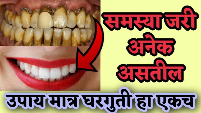 दातांचा पिवळेपणा घालवण्यासाठी हा घरगुती उपाय एकदा नक्की करा; दात चांदीसारखे चमकायला लागतील.!