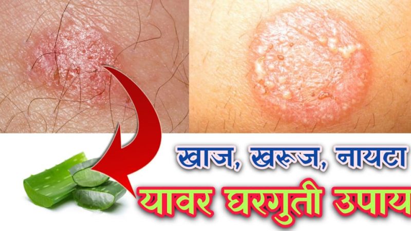 ही फक्त १ वस्तू जांघेतील, मांड्यांवरील आणि इतर कुठलेही नायटे,खाज गजकर्ण मुळापासून बरे करते.!