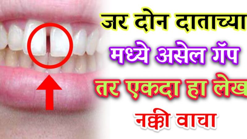 जर तुमच्या सुद्धा दातांमध्ये आहे असा गॅप तर ही माहिती जरूर वाचा; नाहीतर होतील हे गंभीर परिणाम.!