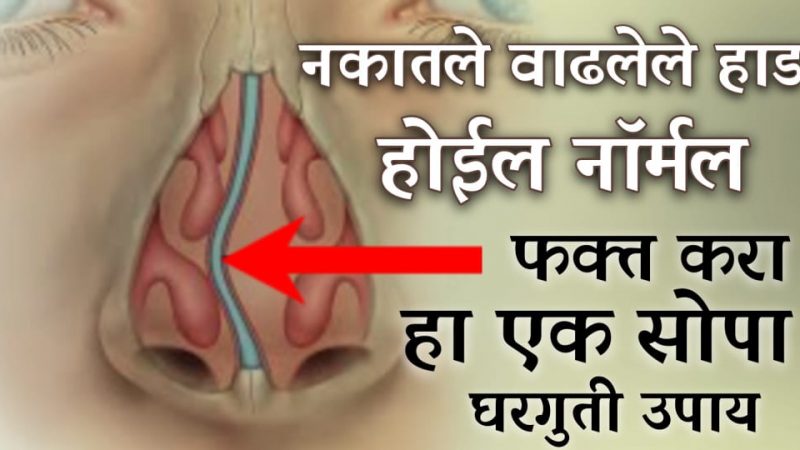 नाकाचे वाढलेले हाड १ दिवसातच करेल कमी; करा हा रामबाण घरगुती उपाय.!