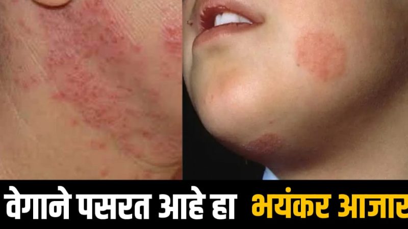 आजकाल खूप झपाट्याने पसरत आहे हा आजार; एकदा नक्की वाचा याबद्दल माहिती नाहीतर नंतर पच्छाताप होईल.!