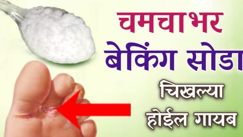 फक्त १ चमचा बेकिंग सोडा पायातील चिखल्या रात्रीतून करेल गायब; घरगुती फंगल इन्फेक्शन उपाय.!