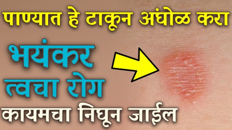 फक्त 1 वेळ पाण्यात हे टाकून अंघोळ करा; भयंकर त्वचारोग गायब करेल ही वस्तू.!