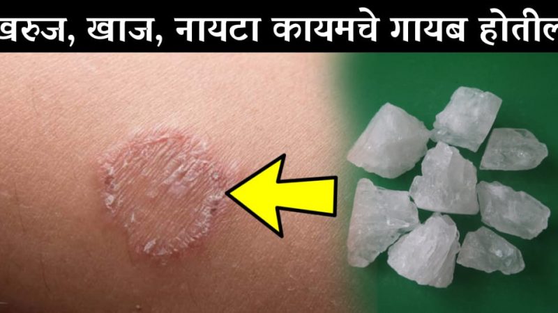 खाज, खरूज, नायटा, गजकर्ण कितीही वर्षे असू द्या जुना फक्त दोन दिवसांमध्ये मिळेल त्याच्यापासून मुक्तता.!