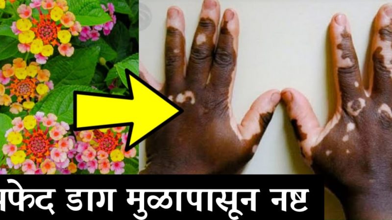 जर चेहऱ्यावर झाले असतील पांढरे डाग तर करा हा उपाय; काही दिवसात त्वचा होईल पहिल्यासारखी.!