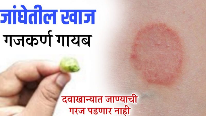 हे औषध घरीच बनवून लावा; नायटा, गजकर्ण कायमचा जाईल, जरासुद्धा डाग राहणार नाही.!