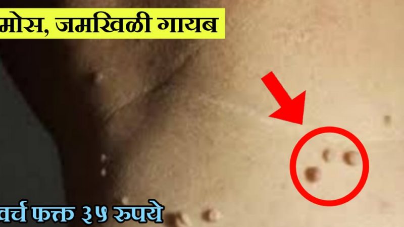 मस्सा, मोस, चामखीळ गळून पडेल,मग ती शरीरावर कुठेही असो; फक्त करा याचा असा उपाय.!